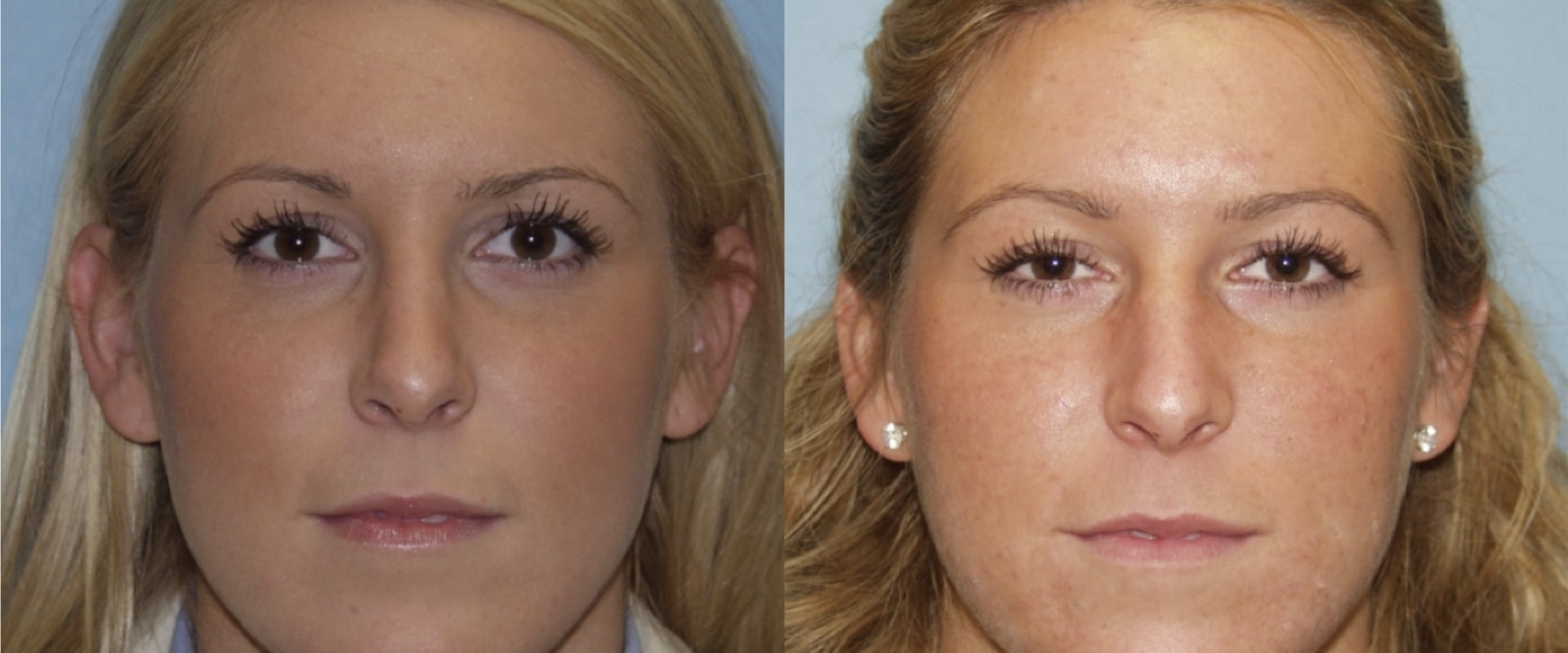 Who is the top rhinoplasty doctor in usa?