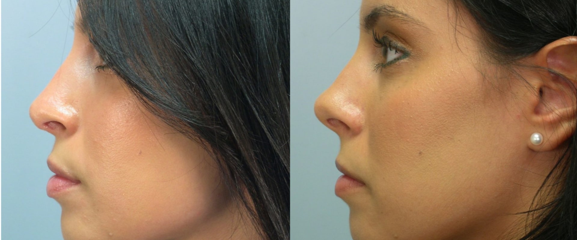 How does insurance cover nose job?