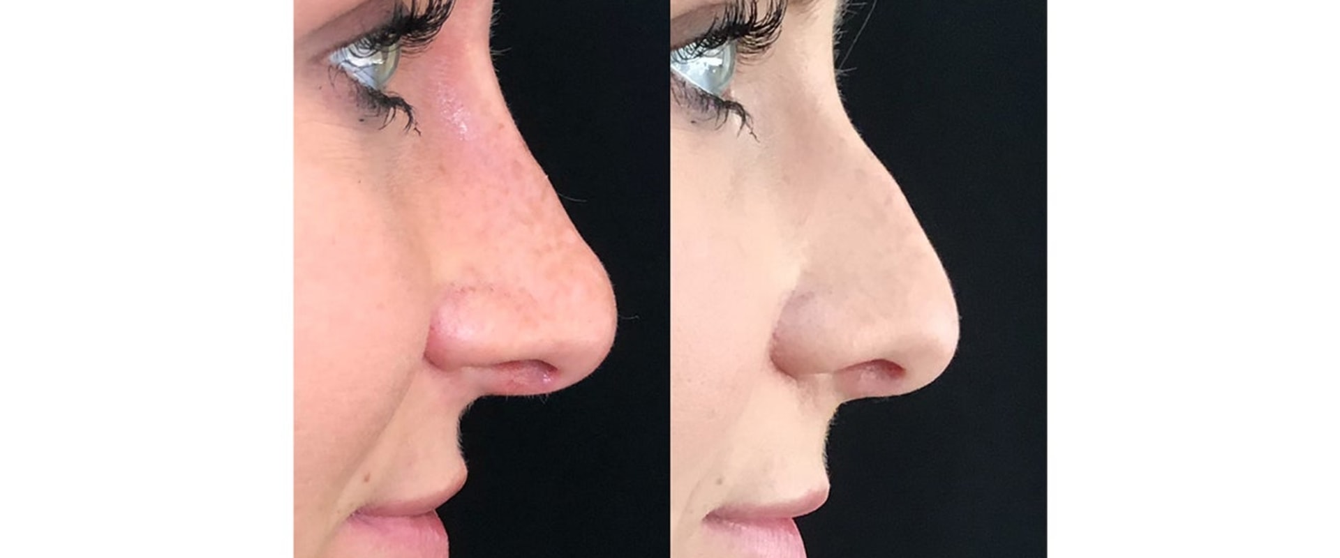 The Truth About Non-Surgical Nose Surgery
