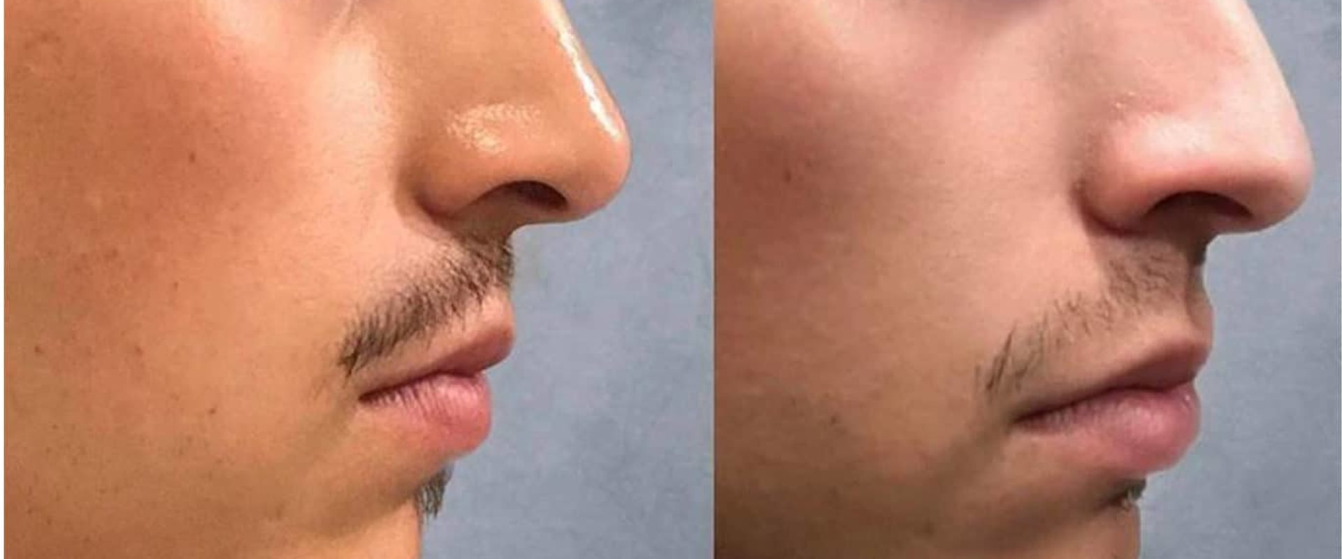 The Longevity of a Nose Job: What You Need to Know