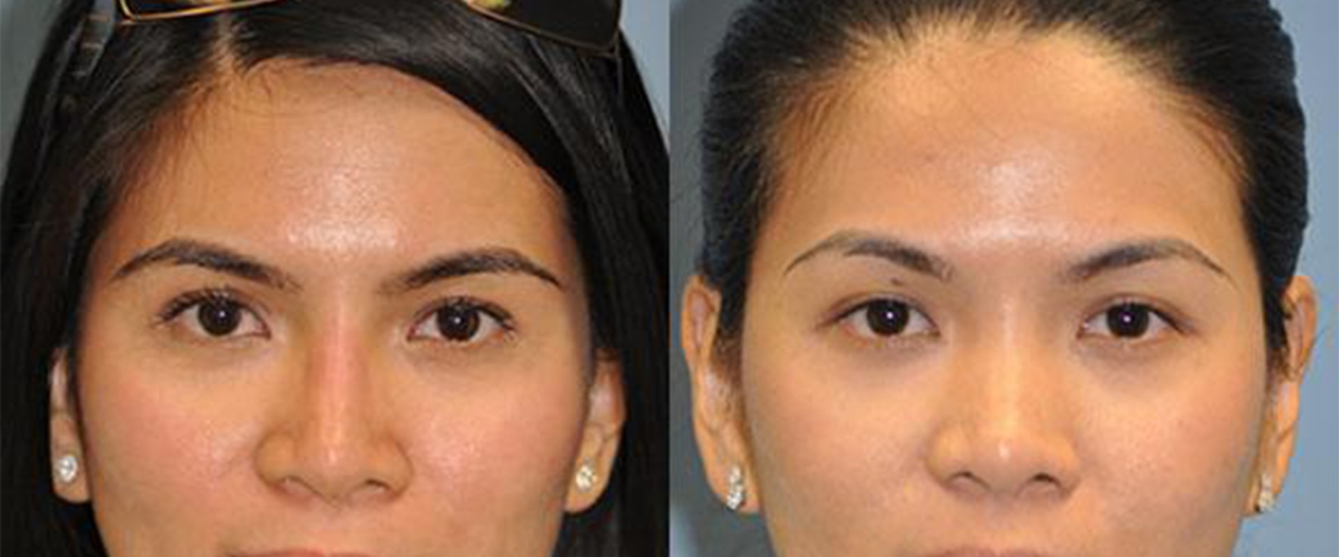 The Truth About Permanent Nose Reshaping: An Expert's Perspective