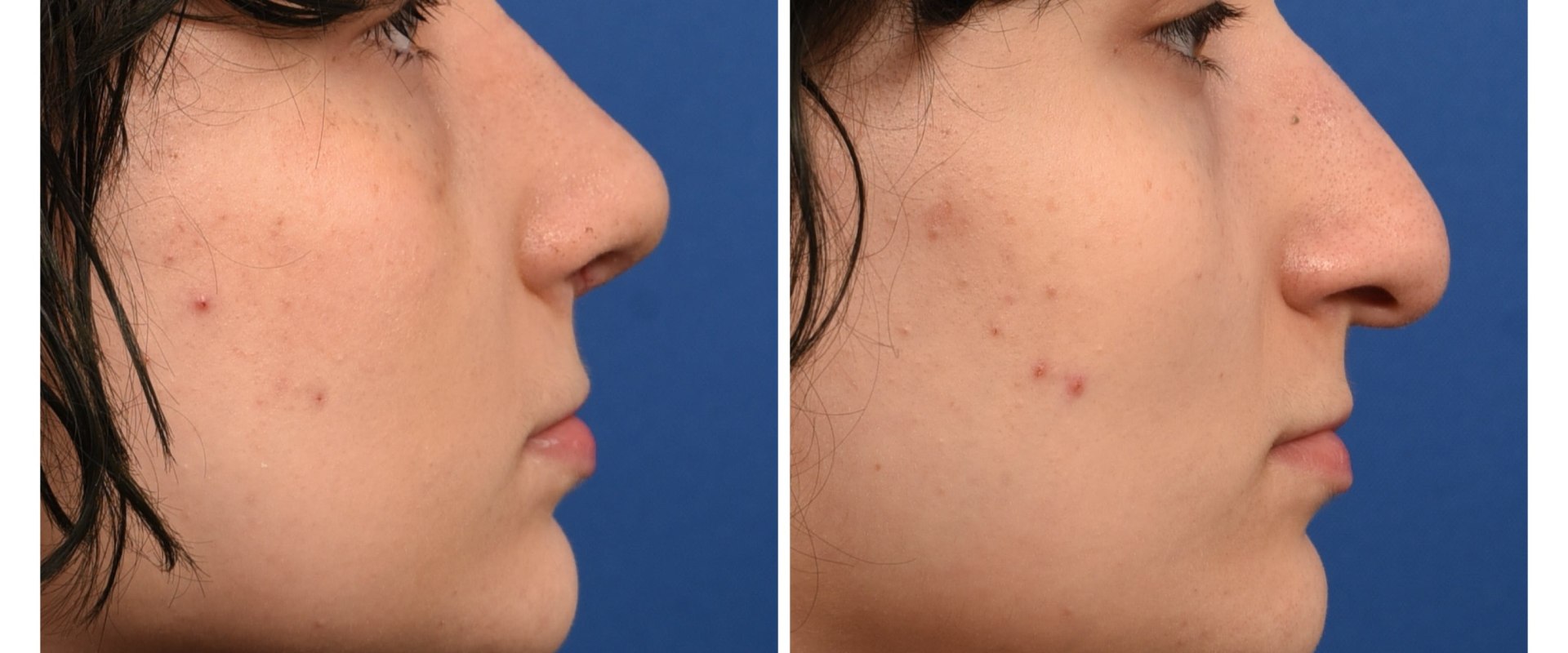 The Secret to Long-Lasting Rhinoplasty Results