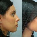 The Cost of a Nose Job: How to Afford the Procedure