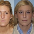 Who is the top rhinoplasty doctor in usa?