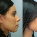 How does insurance cover nose job?