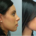 The Affordable Guide to Rhinoplasty: Expert Tips for a Perfect Nose