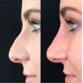 The Truth About Non-Surgical Nose Surgery