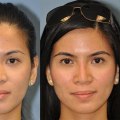 The Truth About Permanent Nose Reshaping: An Expert's Perspective