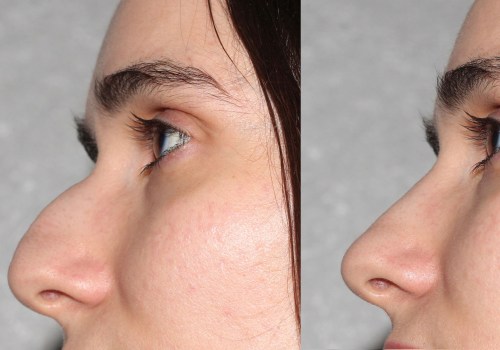 The Evolution of Minimally Invasive Rhinoplasty