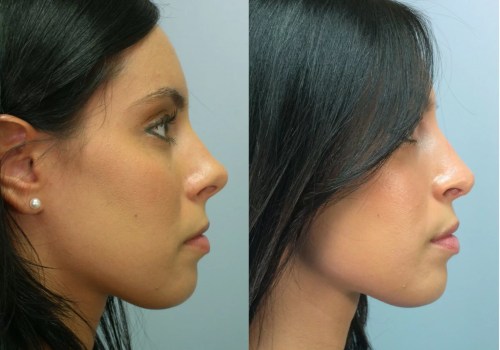 The Cost of a Nose Job: How to Afford the Procedure