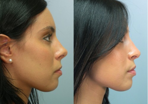 How does insurance cover nose job?