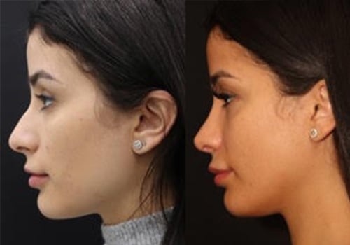 Where is the most affordable place to get a rhinoplasty?