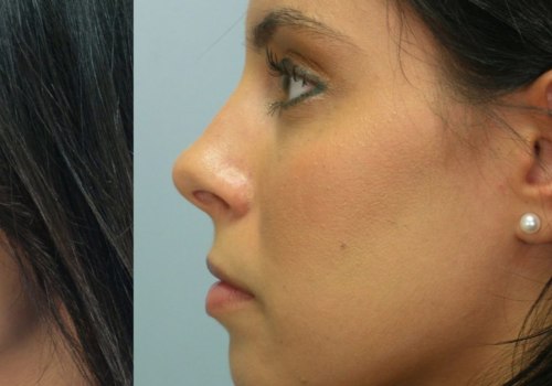 The True Cost of a Nose Job: What You Need to Know