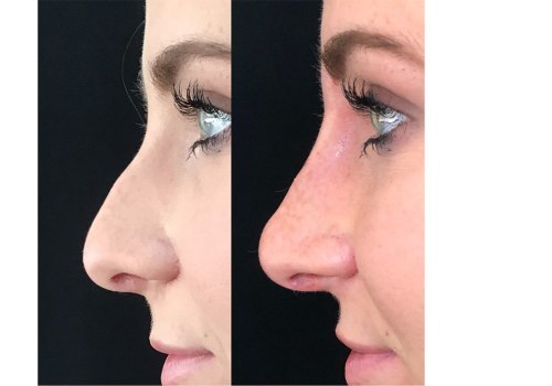 The Truth About Non-Surgical Nose Surgery