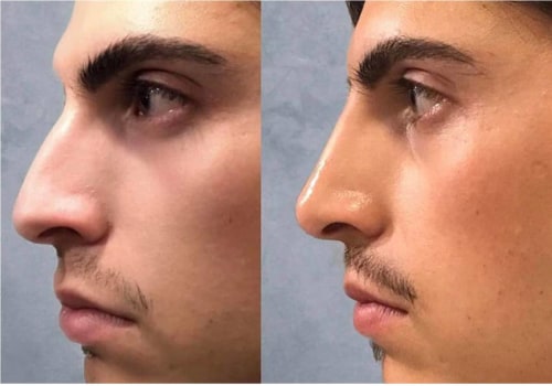 The Longevity of a Nose Job: What You Need to Know