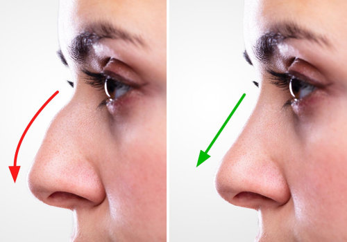 The Ultimate Guide to Choosing the Perfect Nose Job for Your Face