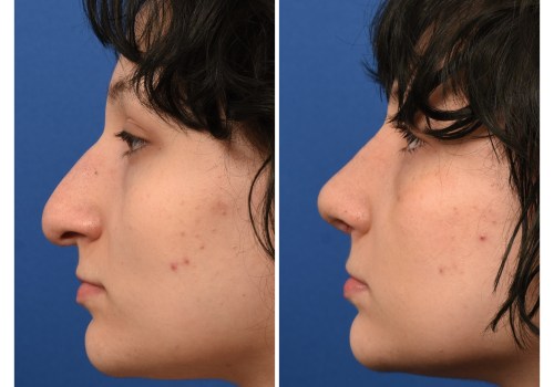 The Secret to Long-Lasting Rhinoplasty Results